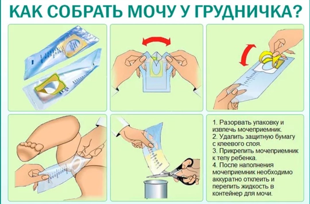 Не могу пописать первая помощь. Мочесборник для новорожденных мальчиков как одевать. Емкость для сбора мочи у новорожденных мальчиков. Как собрать мочу у новорожденного мальчика для анализа. Как собрать мочу у ребенка новорожденного мальчика.