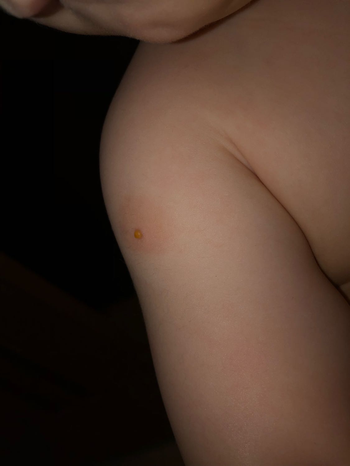 Всем привет, у ребёнка от укуса комара появился такой волдырик с жидко... image №3