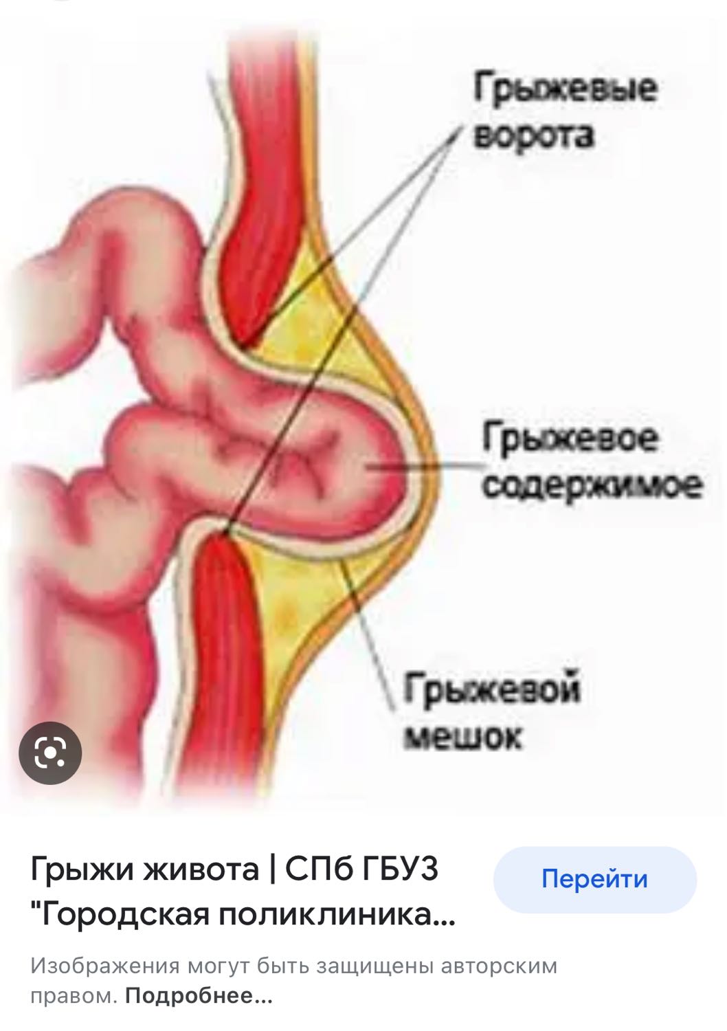 Здравствуйте! У меня была полосная операция на животе в 2018 г . Из за... 