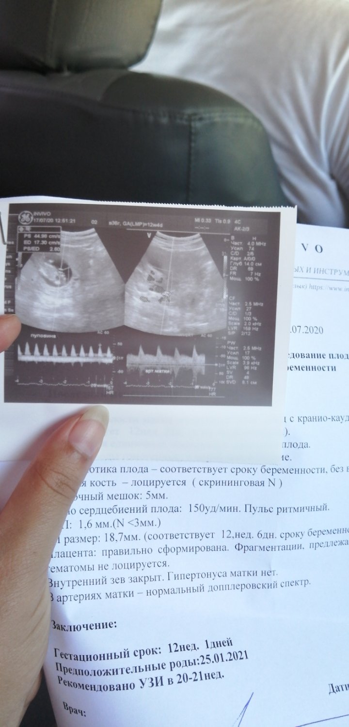 Первый скрининг. Увидела своего малыша. Пол правда не сказали. Но прыг... 
