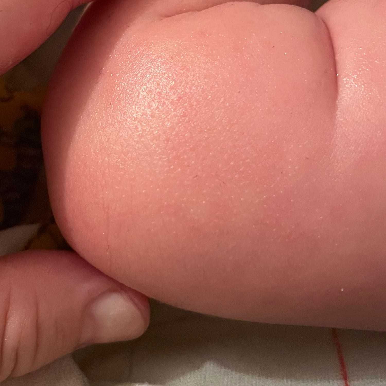 Всем привет. Девочки моей дочке 1,5 месяцев. На коже появились такие в... 
