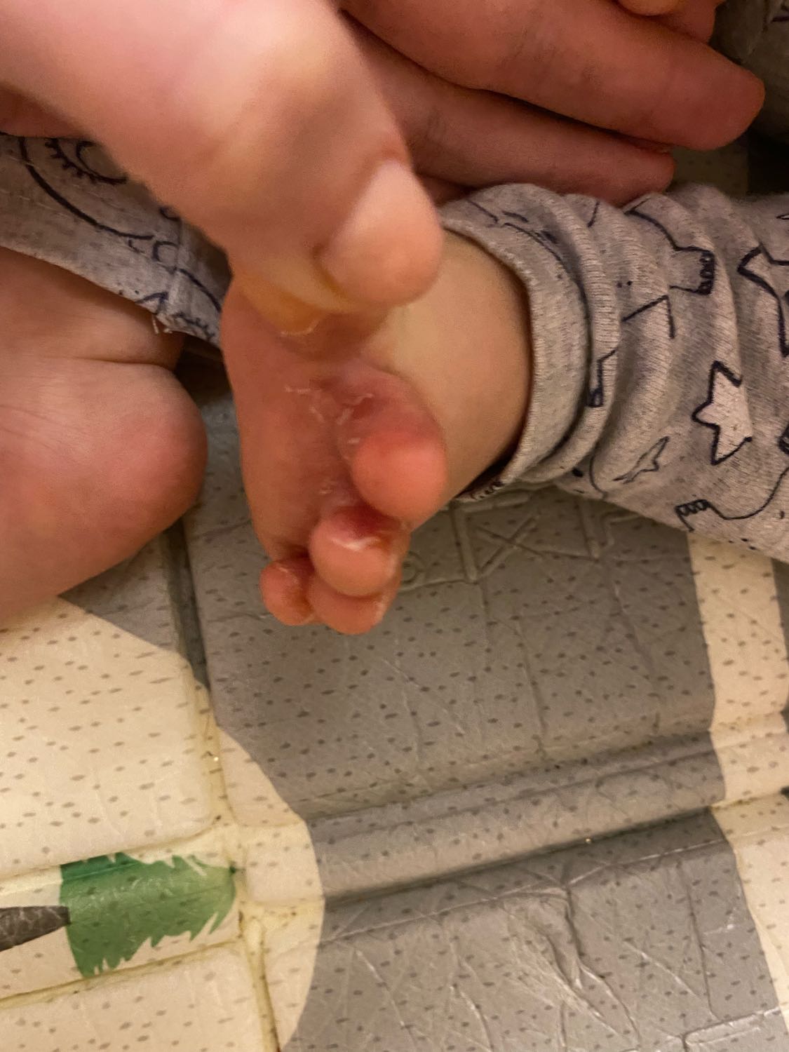 Сегодня обнаружила, что у ребенка кожа облазит на пальчиках ног. На чт... image №4