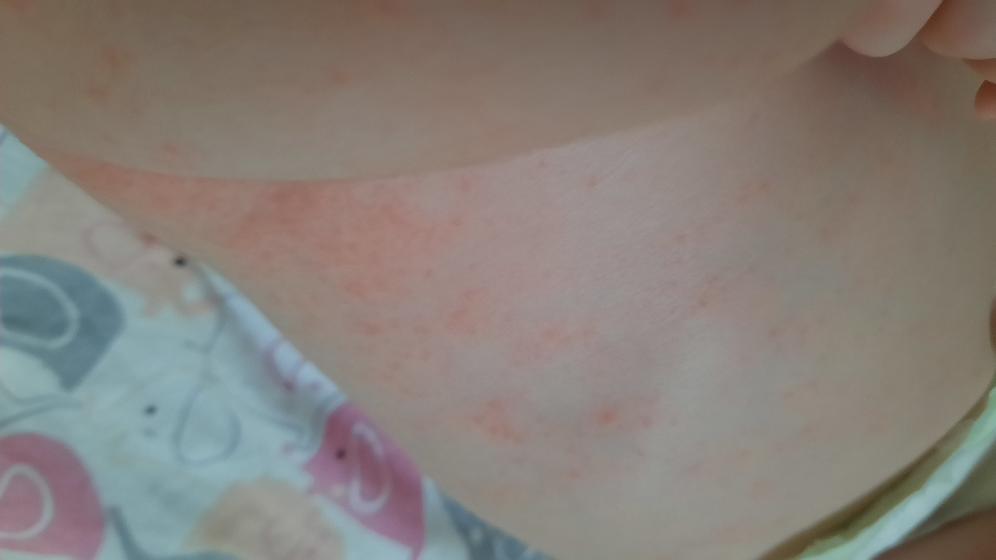 Девчёнки помогите,что это потничка или алергия???😫😱 image №4