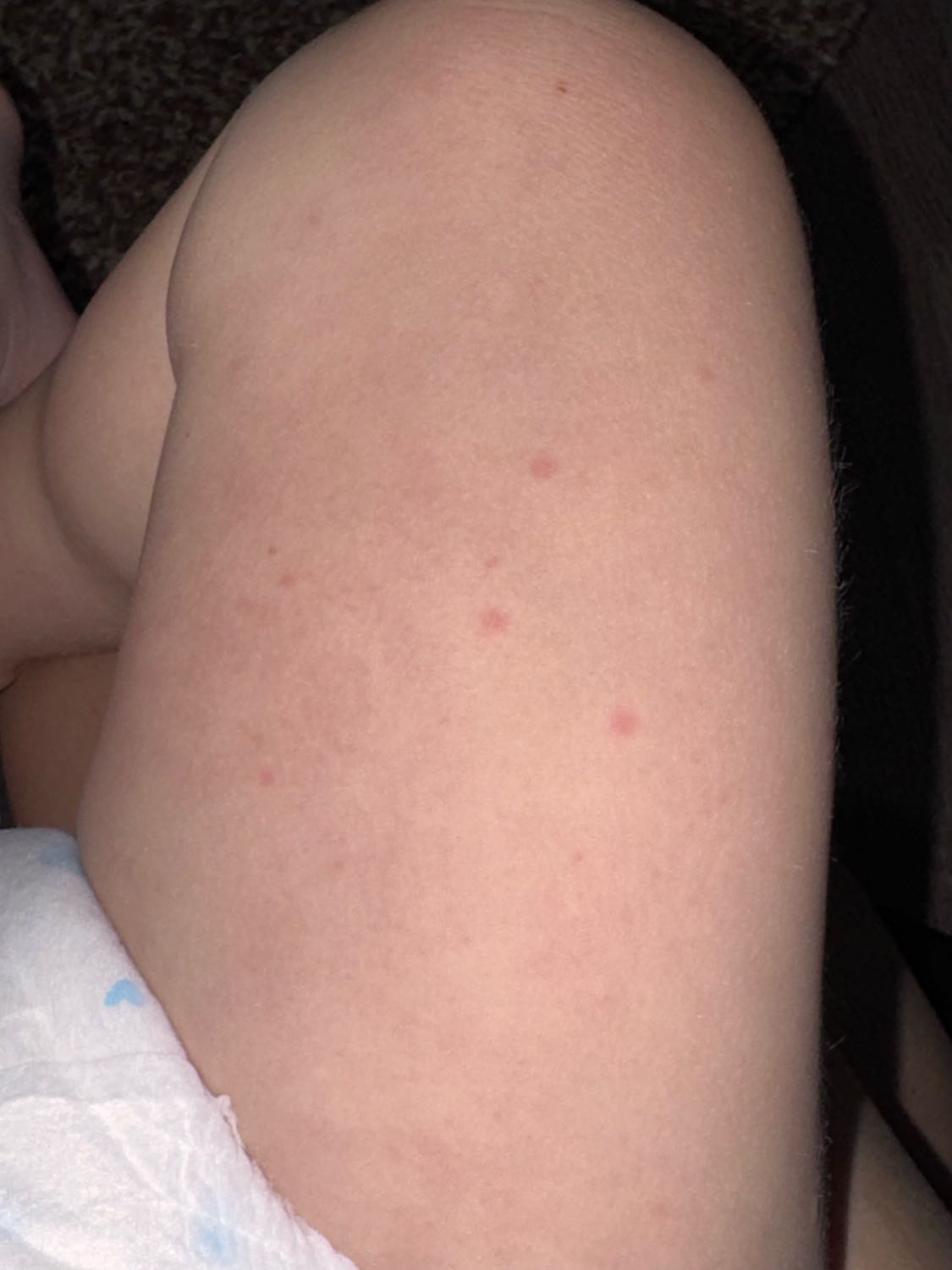 Please tell me, does this look like a food allergy? — 2