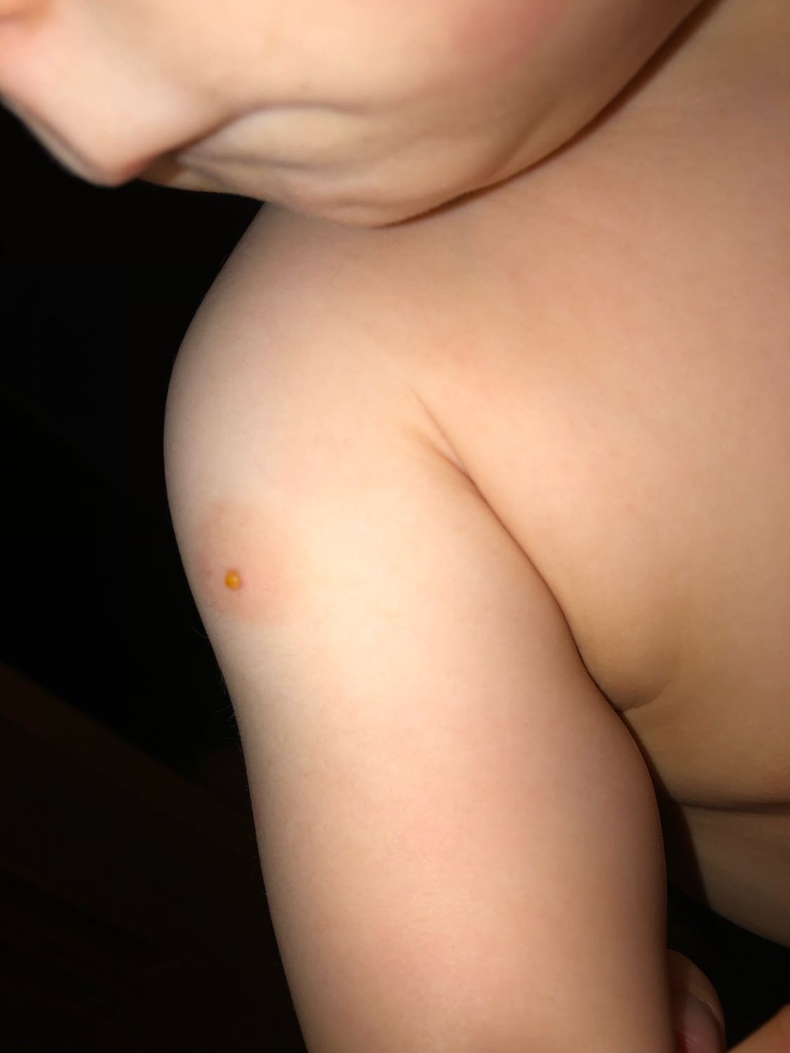Всем привет, у ребёнка от укуса комара появился такой волдырик с жидко... image №2
