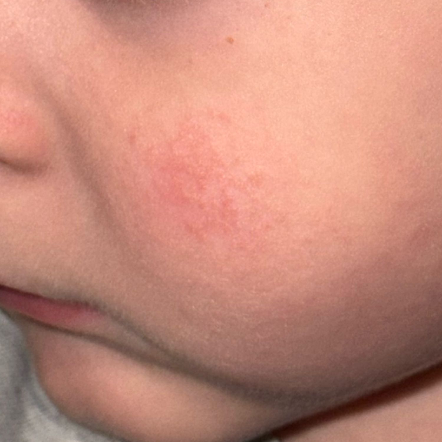 Please tell me, does this look like a food allergy? — 3