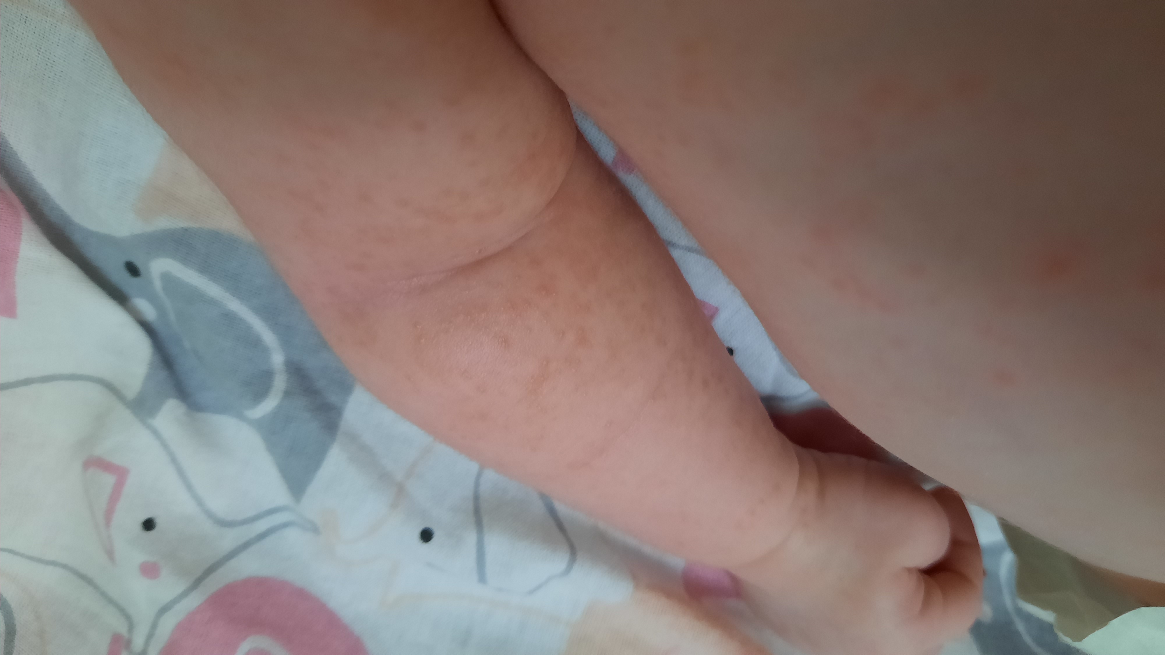 Девчёнки помогите,что это потничка или алергия???😫😱 image №3