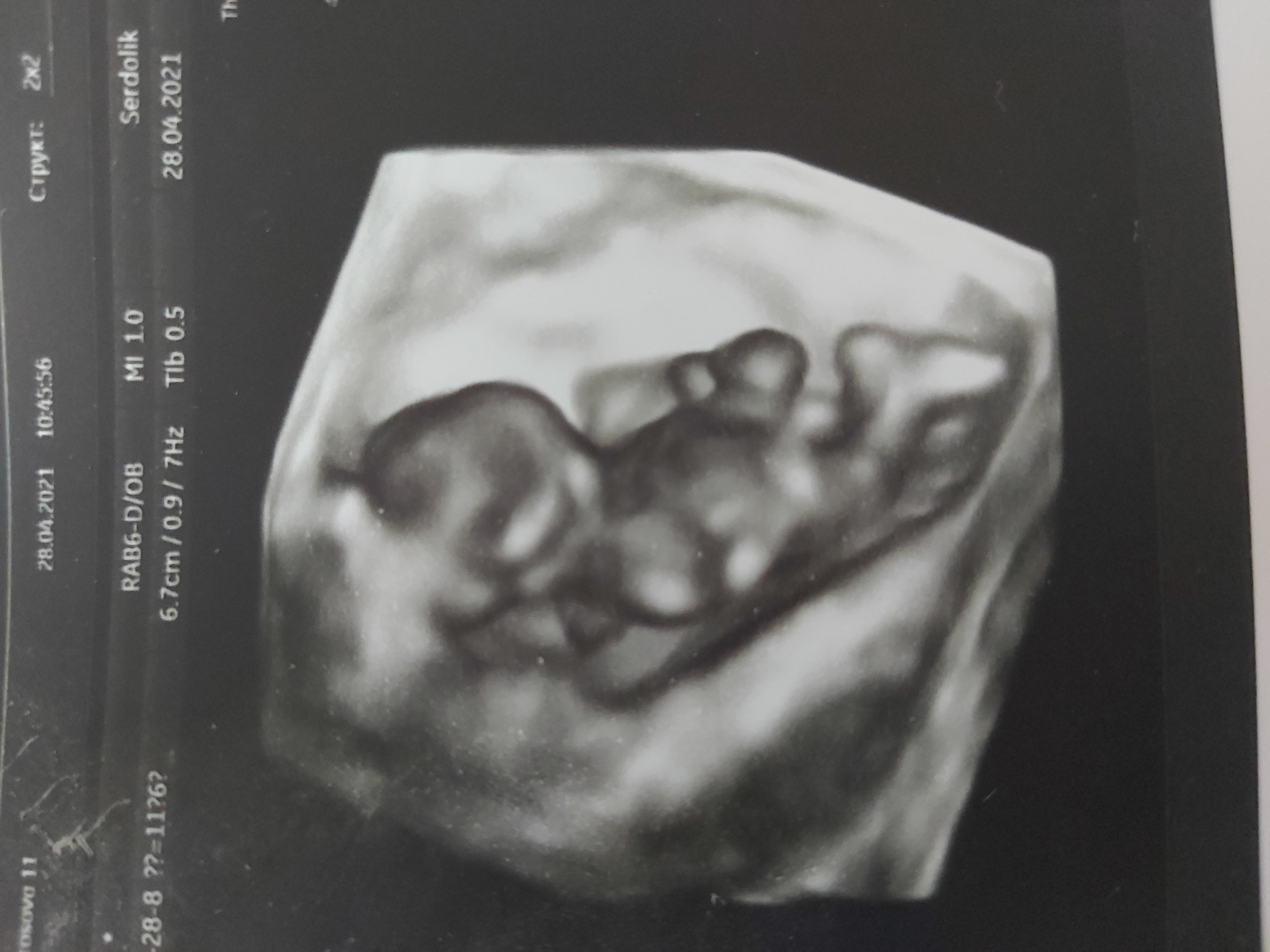 Всем ДД! Срок на фотках одинаковый, слева первая беременность. Справа ... image №4