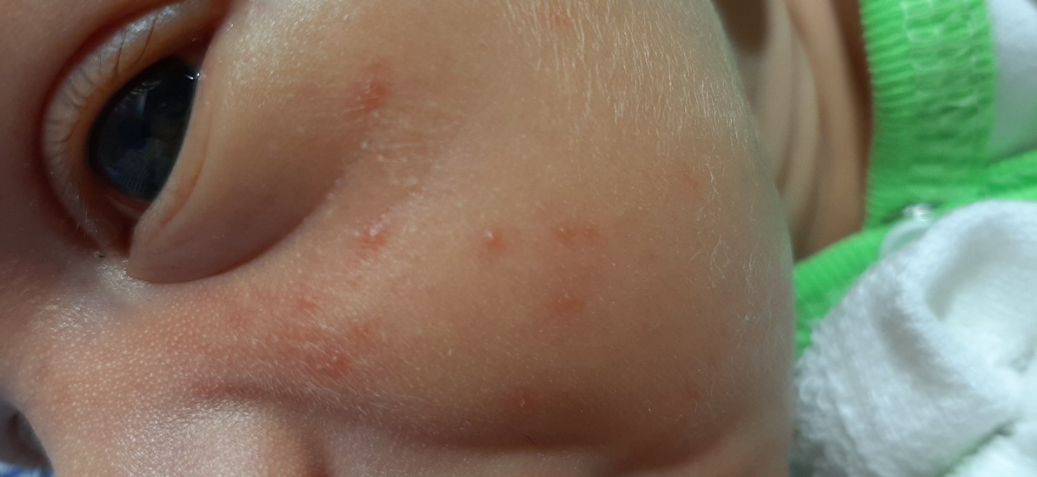 Девченки кто понимает, это акне новорожденных, потничка или алергия? image №2