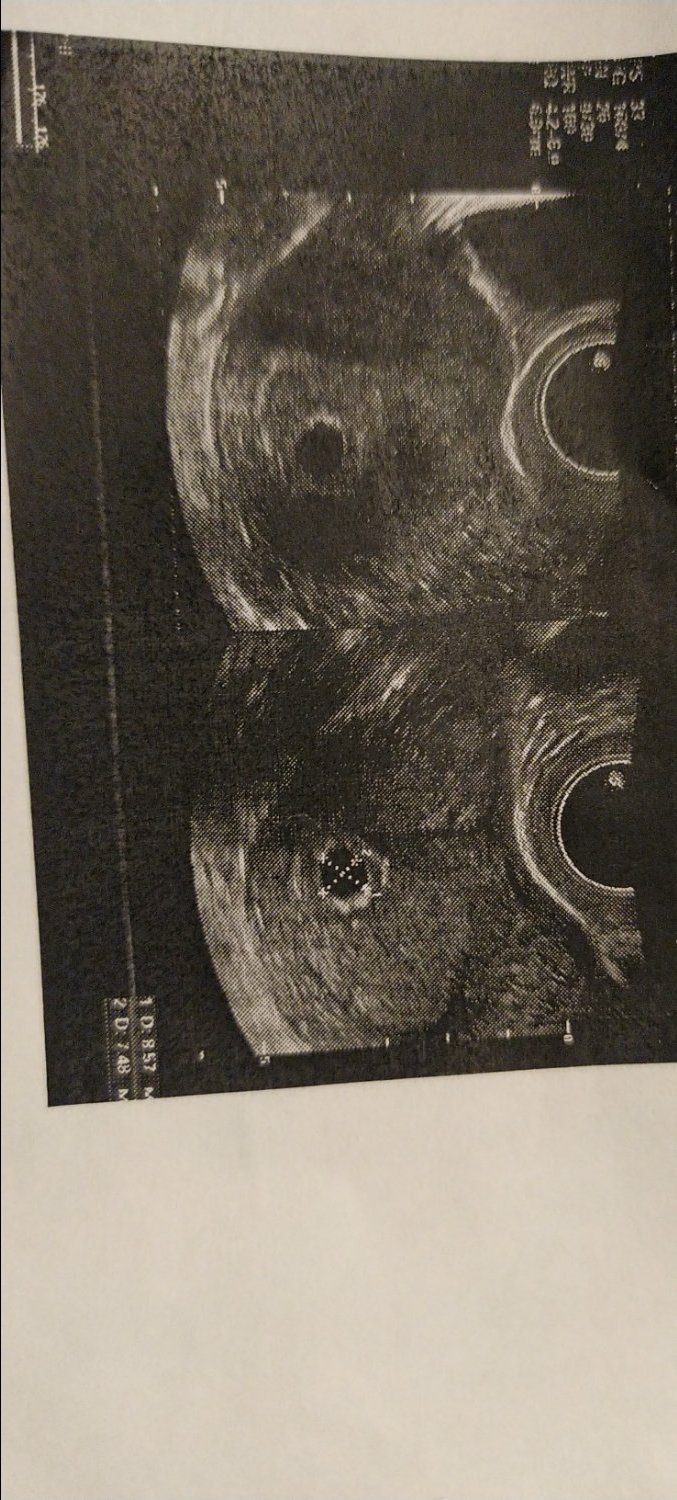 Привет. Может ли быть  не виден эмбрион на УЗИ? Овуляция поздняя была ... image №2