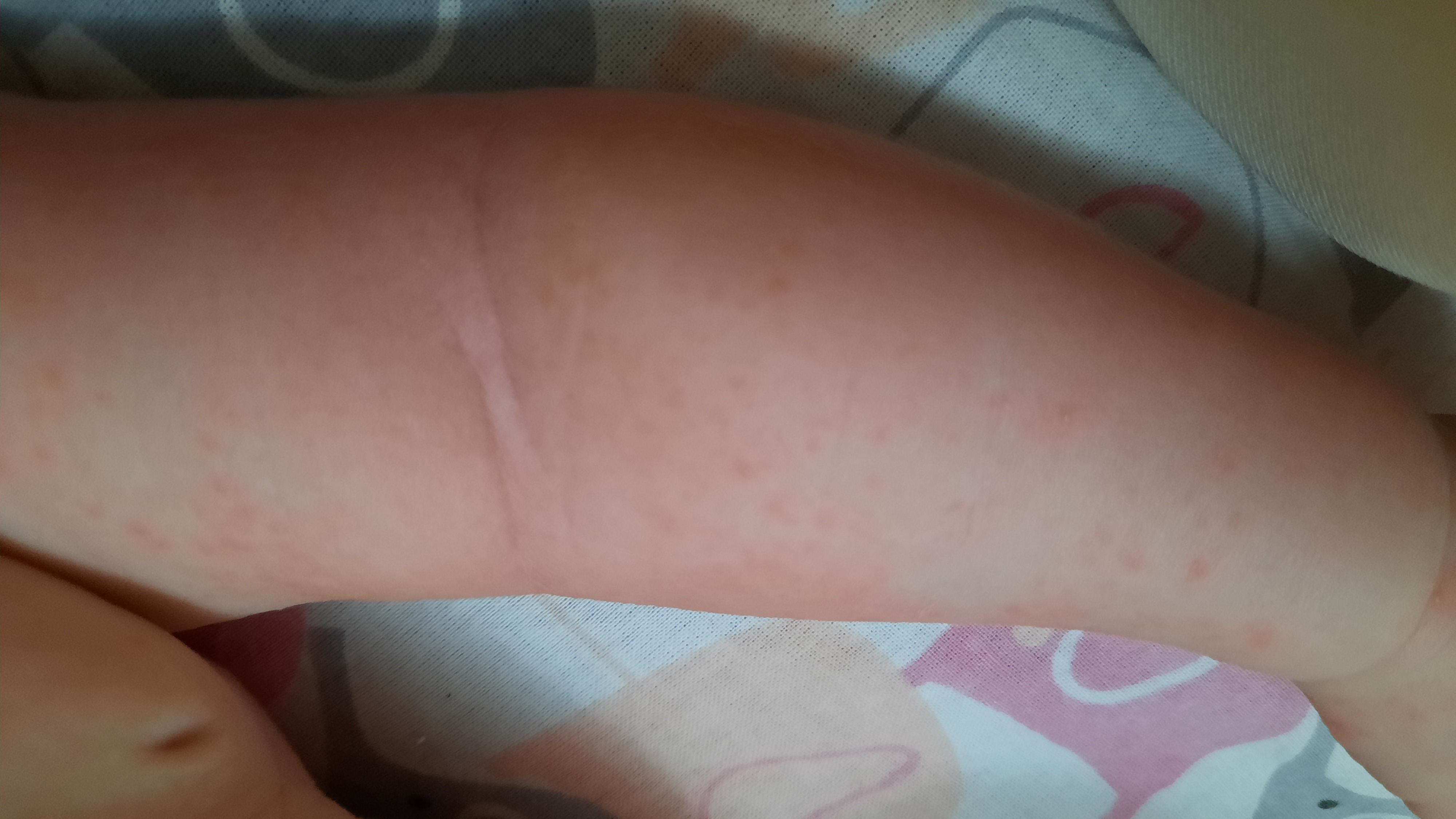 Девчёнки помогите,что это потничка или алергия???😫😱 image №2