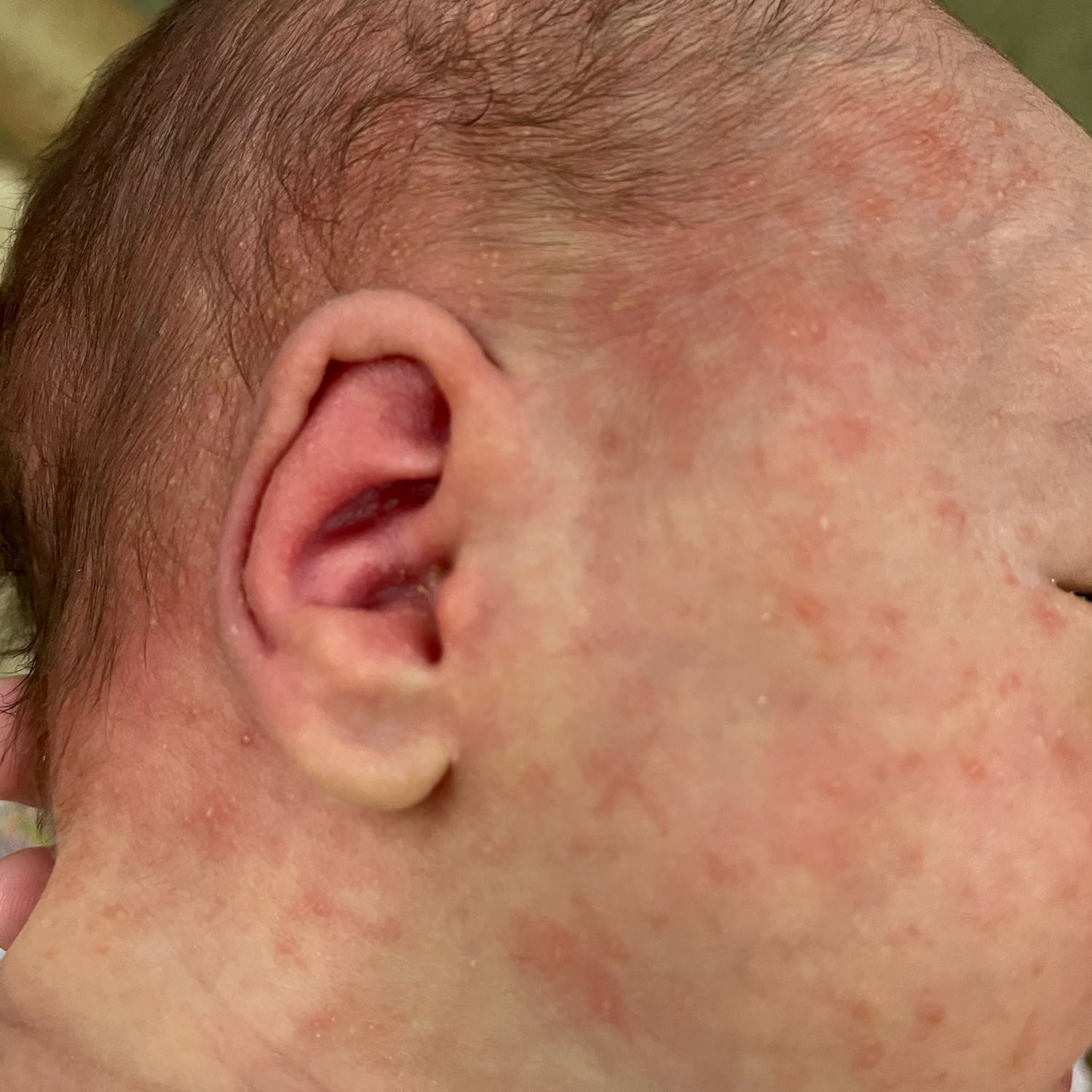 ребенку месяц на лице и шее сыпь появились можно чем нибудь мазать беп... 
