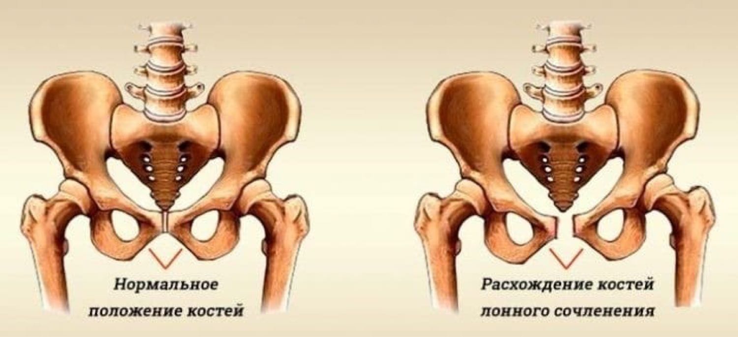 Расширение таза при беременности. Диастаз костей лонного сочленения. Симфизит тазобедренного сустава. Лобковая кость симфиз. Лонное сочленение и лобковая кость.