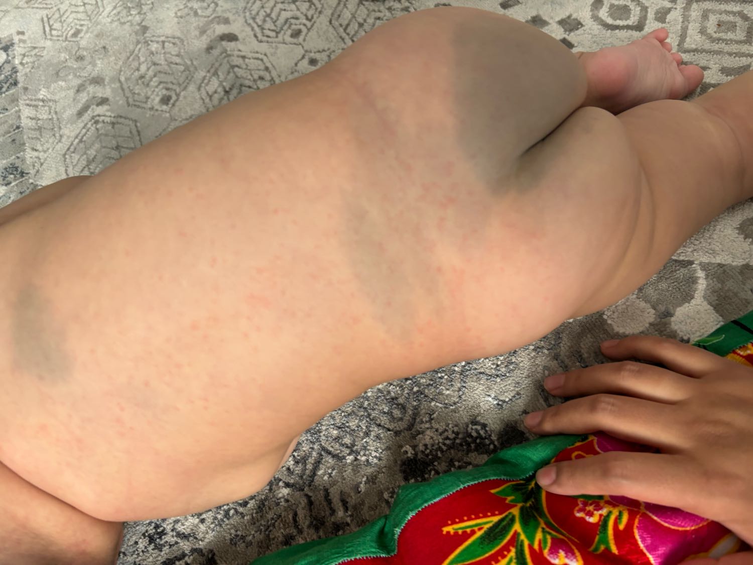 Всем привет! это потница или аллергия?Два дня назад температурил 3 дня... image №3
