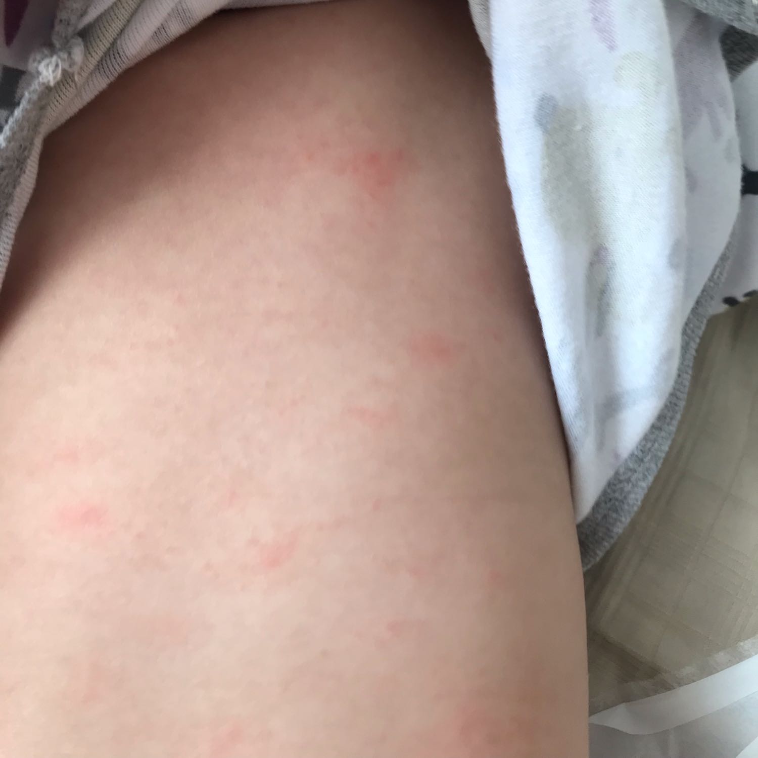 Девочки, аллергия? Вчера вечером появилось, из нового ничего не ела. М... image №2