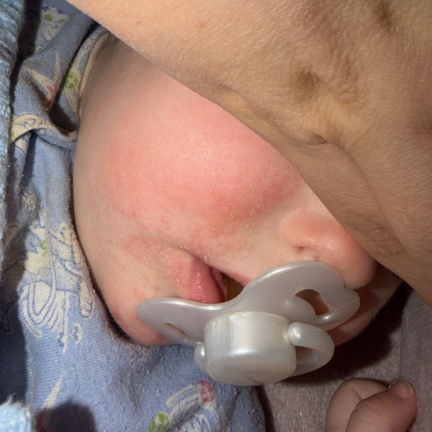 Please tell me, what could this be?
At first a small rash with flaking…