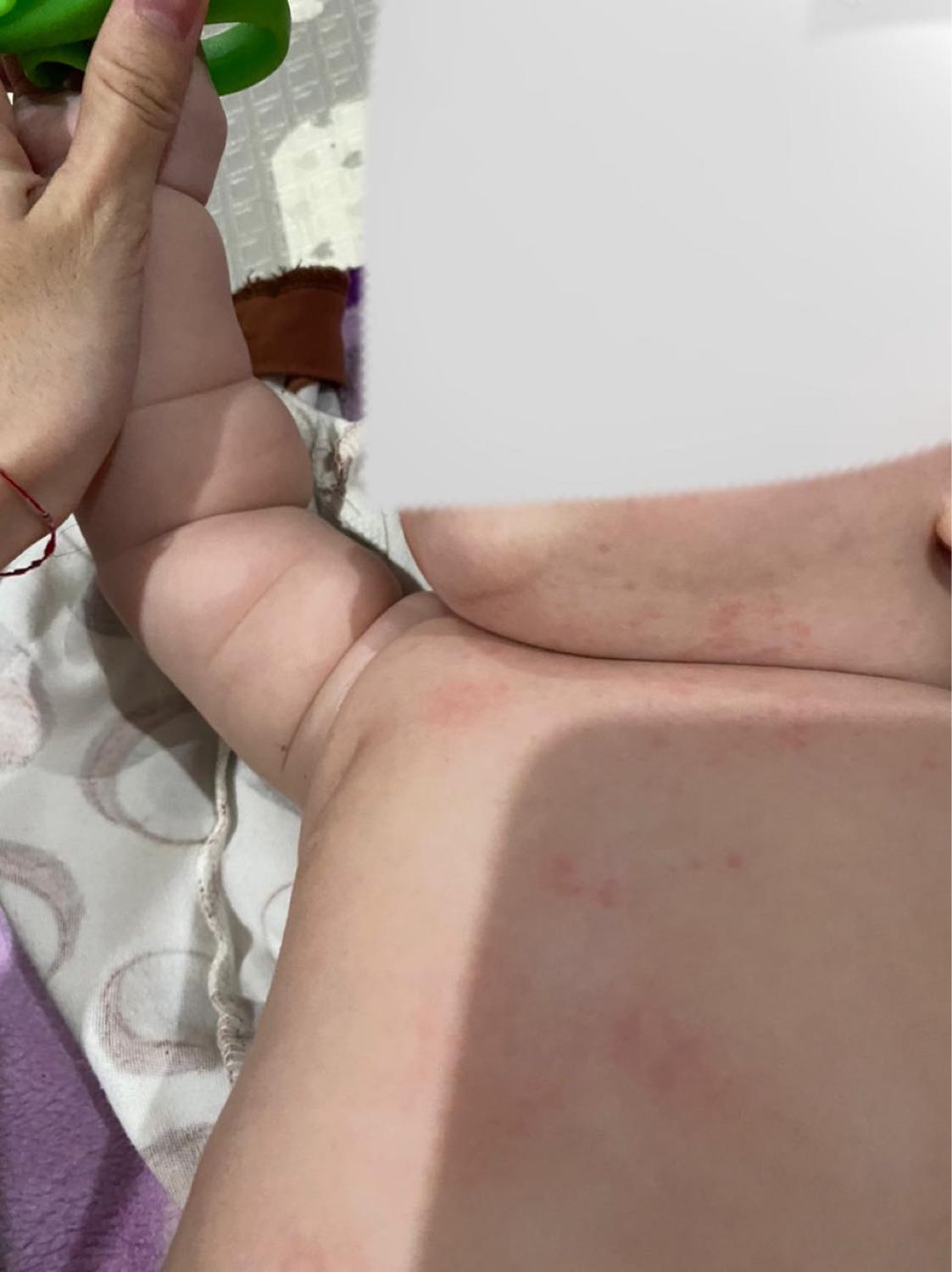 Не знаете что за сыпь у кого такое было image №3